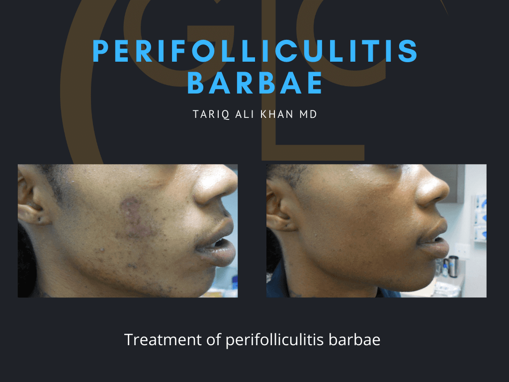 Gentle Care Laser Tustin Before and After picture - perifolliculitis barbae